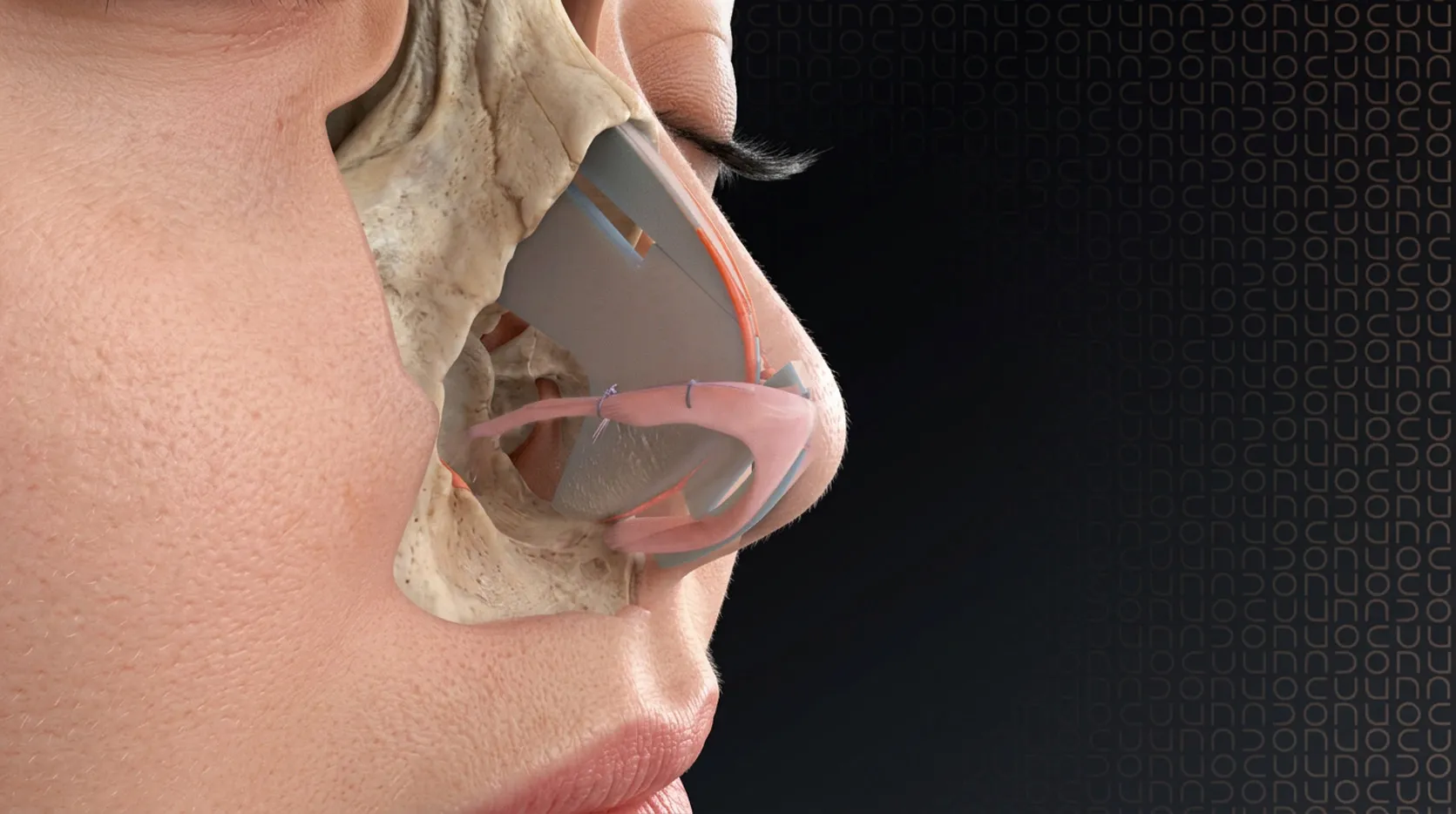 Coupe anatomique 3D d'une rhinoplastie, vue de profil