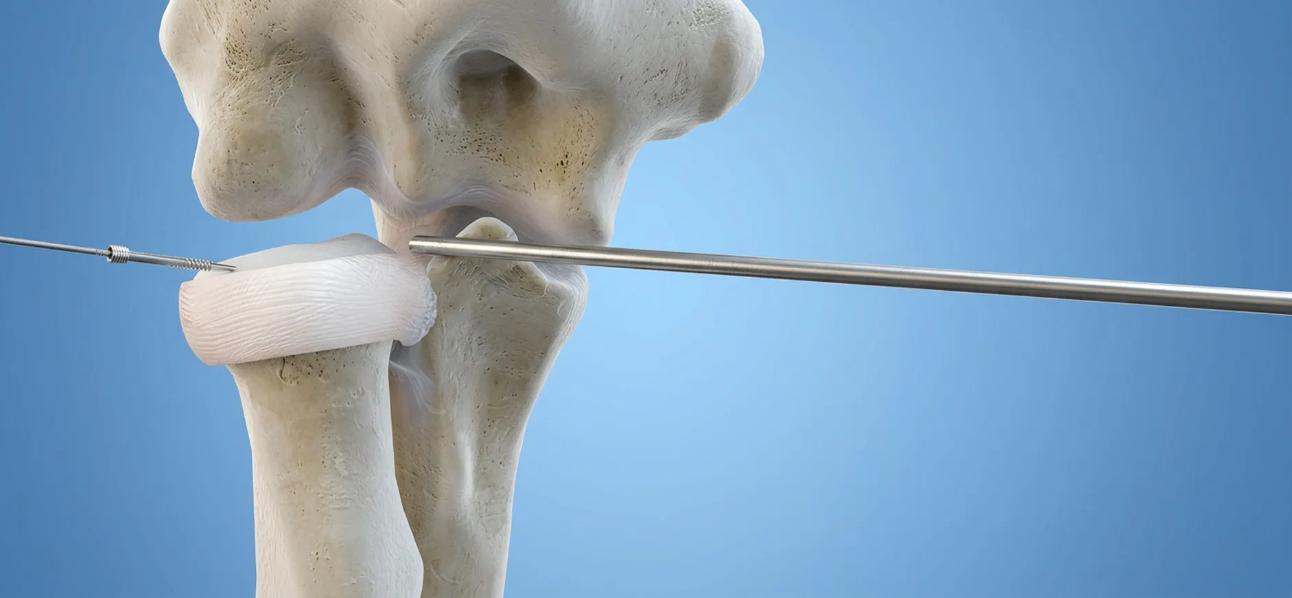 Fracture de la Tête Radiale