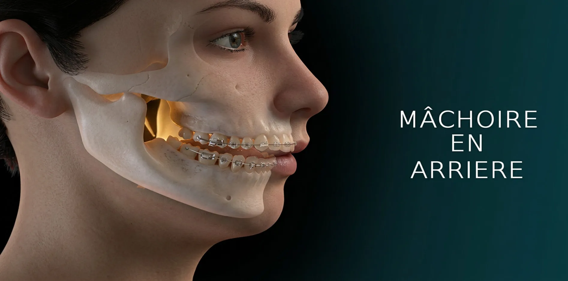 Animation 3D chirurgie de la mâchoire