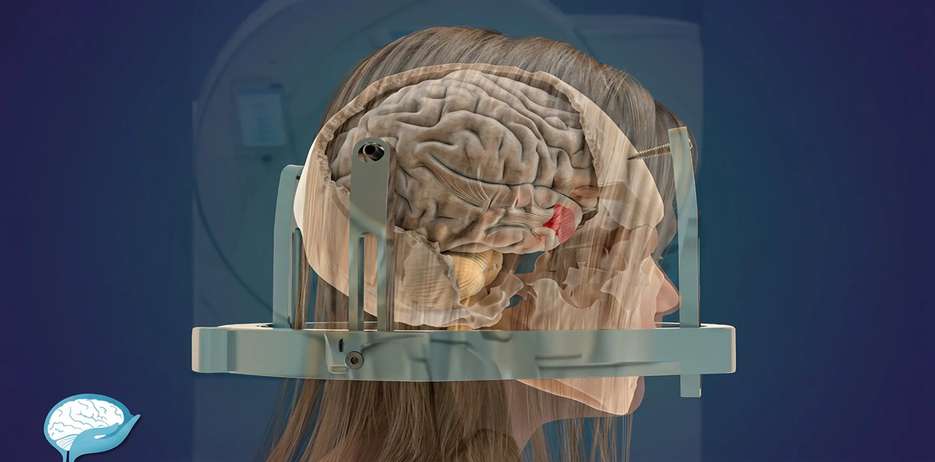 Animation 3D chirurgie Gamma Knife