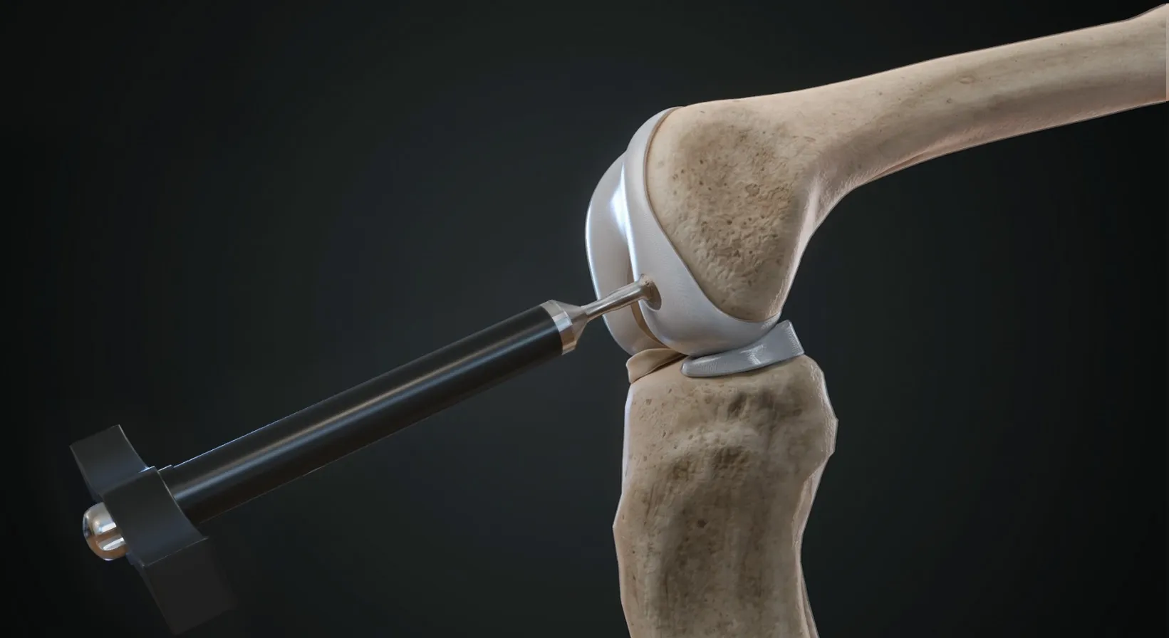 Rendu 3D d'une instrumentation chirurgicale de mosaïcplastie du genou