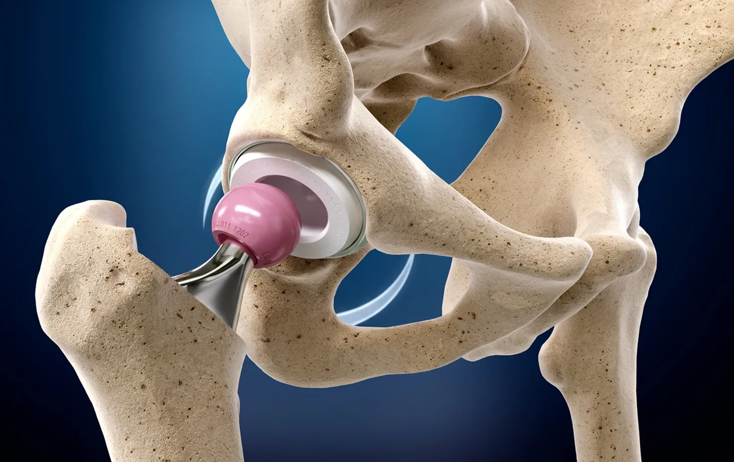 Rendu 3D d'une prothèse totale de hanche en place